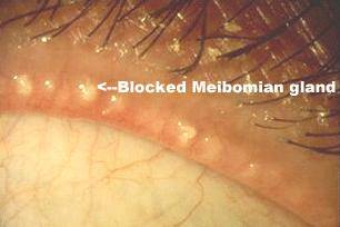 meibomian gland clogged